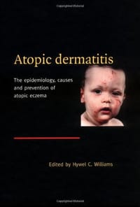 Atopic Dermatitis